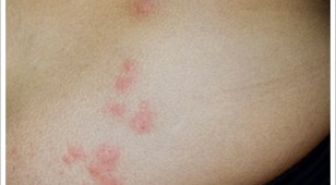 Bed Bug Bites